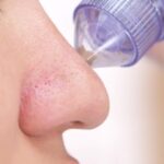 4 In 1 Multi-Function Blackhead Whitehead Extractor Remover Device Facial Cleansing Tool,Skin Cleaner,Pimple Removal Tool,Acne Pimple Pore Cleaner Vacuum Suction Tool For Men & Women (MULTI) - Image 5